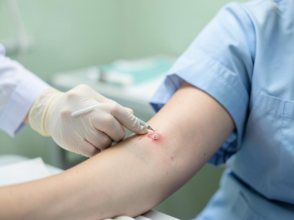 Mole Removal treatment